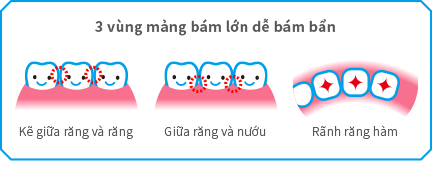 3 vùng mảng bám lớn dễ bám bẩn Kẽ giữa răng và răng Giữa răng và nướu Rãnh răng hàm